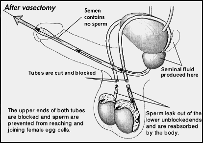 after vasectomy gif