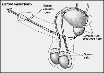 before vasectomy gif