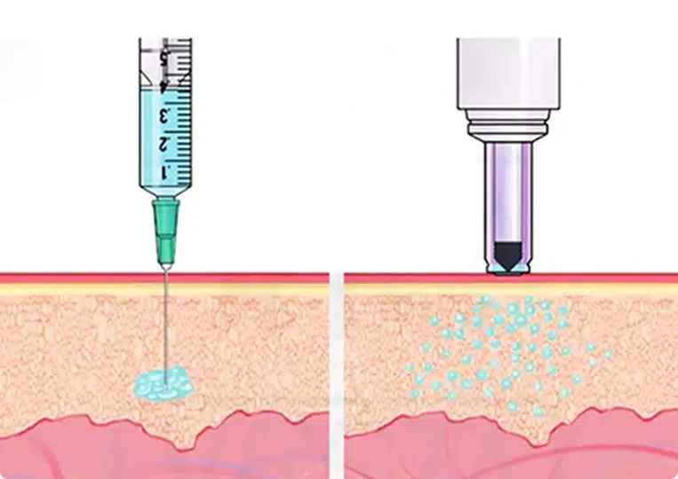 jet injector vasectomy, needleless anaesthesia, no needle vasectomy