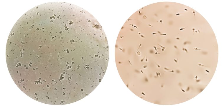 where does sperm go after vasectomy what happens to sperm after vasectomy sperm after vasectomy where does sperm go after a vasectomy